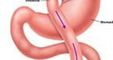 Obesity Bariatric Solutions