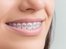 Search and Compare the Best Clinics and Doctors at the Lowest Prices for Braces in Gaziosmanpasa