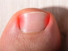 Search and Compare the Best Clinics and Doctors at the Lowest Prices for Ingrown Toenail Treatment in Kepulauan Seribu