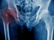 Search and Compare the Best Clinics and Doctors at the Lowest Prices for Hip Fracture Surgery in Malaysia