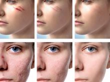 Search and Compare the Best Clinics and Doctors at the Lowest Prices for Scar Removal in kadikoy