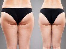 对比位于 普吉岛的Thigh Liposuction 的价格、成本和评论