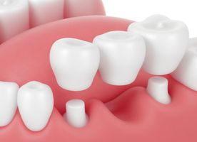 Dental Bridge