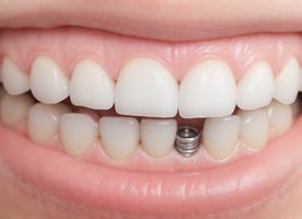 Dental Implant