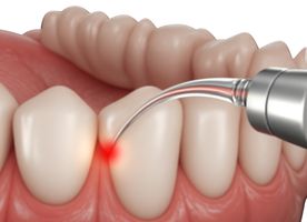 Laser Treatment for Gum Disease
