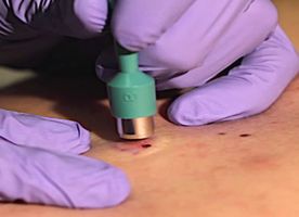 Skin Biopsy