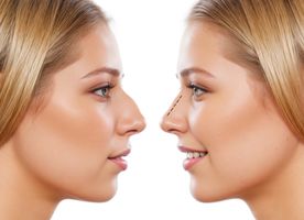 Septoplasty
