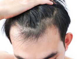 Hair Loss Treatment