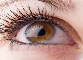 Cornea Transplant
