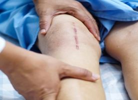 Knee Arthroplasty