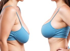 Breast Lift