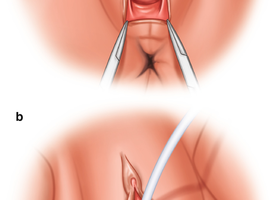 Perineoplasty