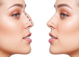 Rhinoplasty