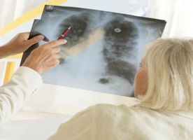 Lung Biopsy