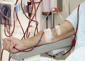 Arteriovenous (AV) Fistula for Dialysis