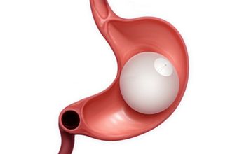 Gastric Balloon Treatment
