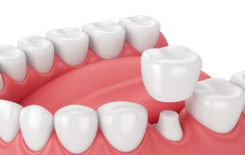 Dental Crown