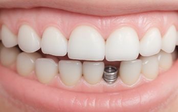 Dental Implant