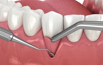 Gum Tissue Graft