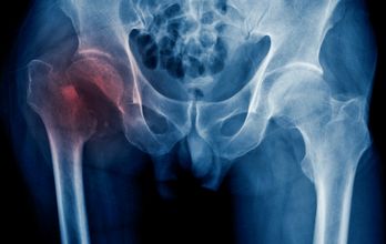 Hip Fracture Surgery