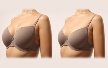 Breast Implant Removal