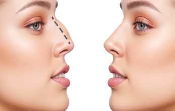 Nose Surgery