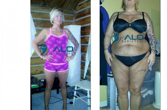 ALO Bariatrics