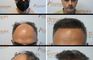 Anastasakis Hair Clinic